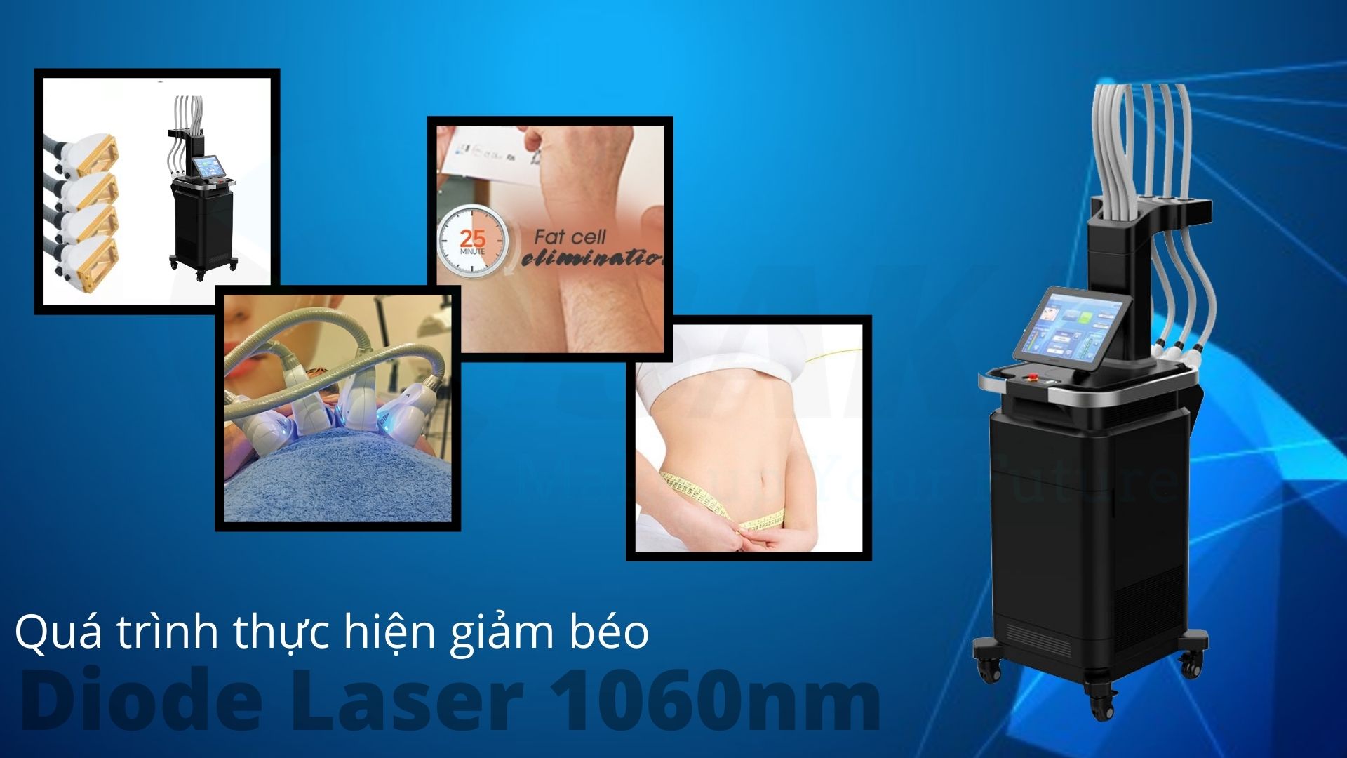 Quá trình thực hiện giảm béo diode laser 1060nm