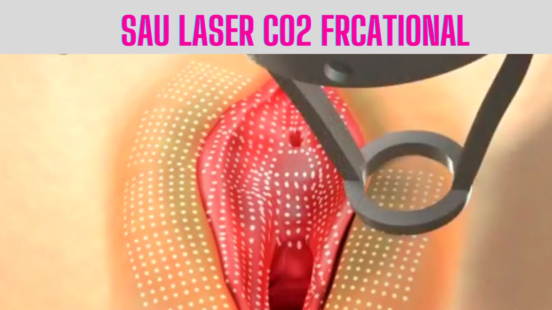Những điều cần biết sau điều trị Laser CO2 Fractional