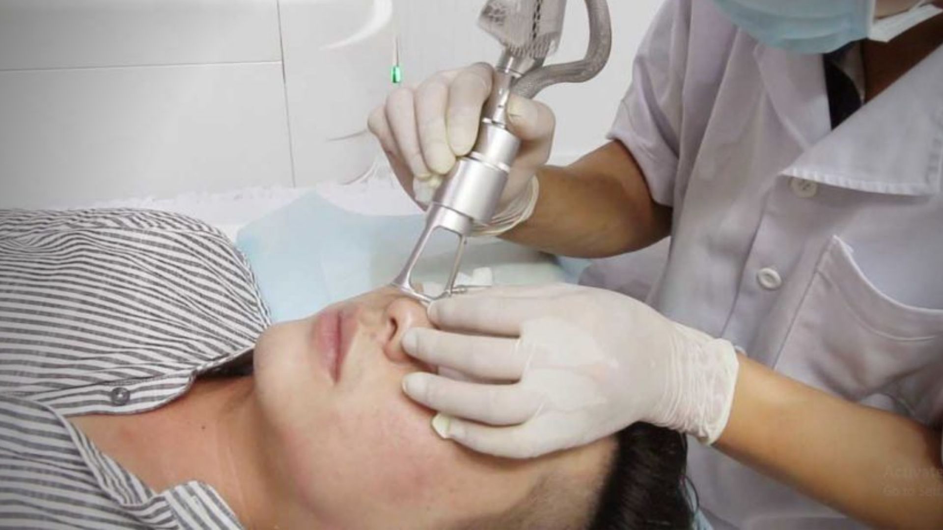 Trị sẹo bằng laser co2 fractional