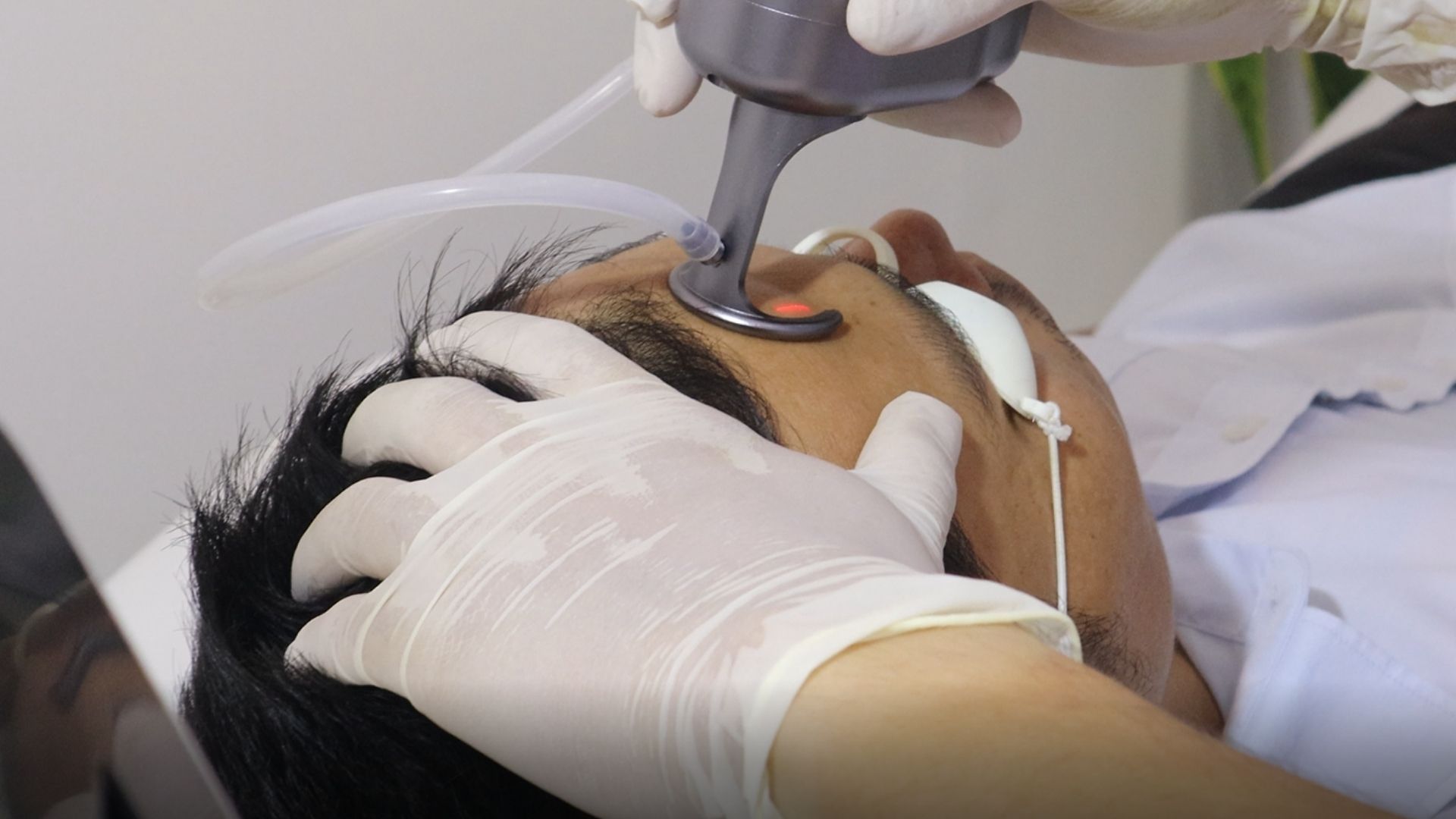 Trị sẹo bằng laser CO2 Fractional