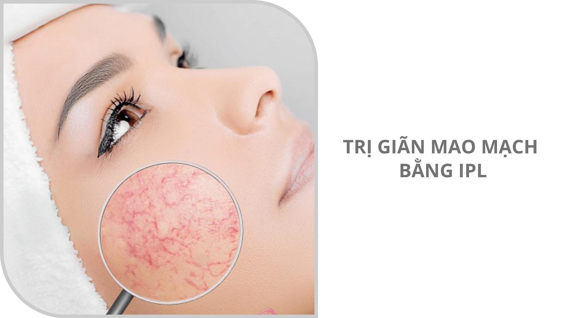 Trị giãn mao mạch bằng IPL
