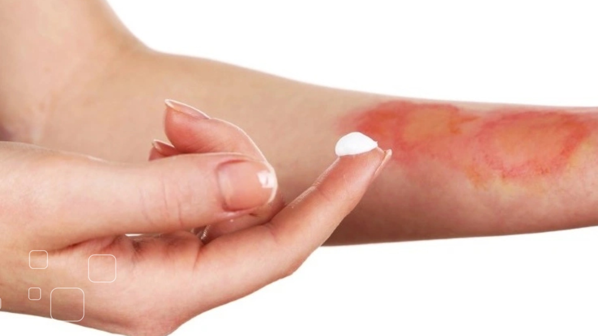 6. Các tác dụng phụ có nguy cơ xảy ra khi dùng máy laser trị sẹo