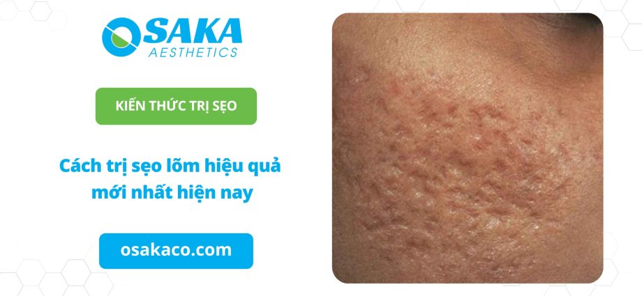 Cách trị sẹo lõm hiệu quả mới nhất hiện nay