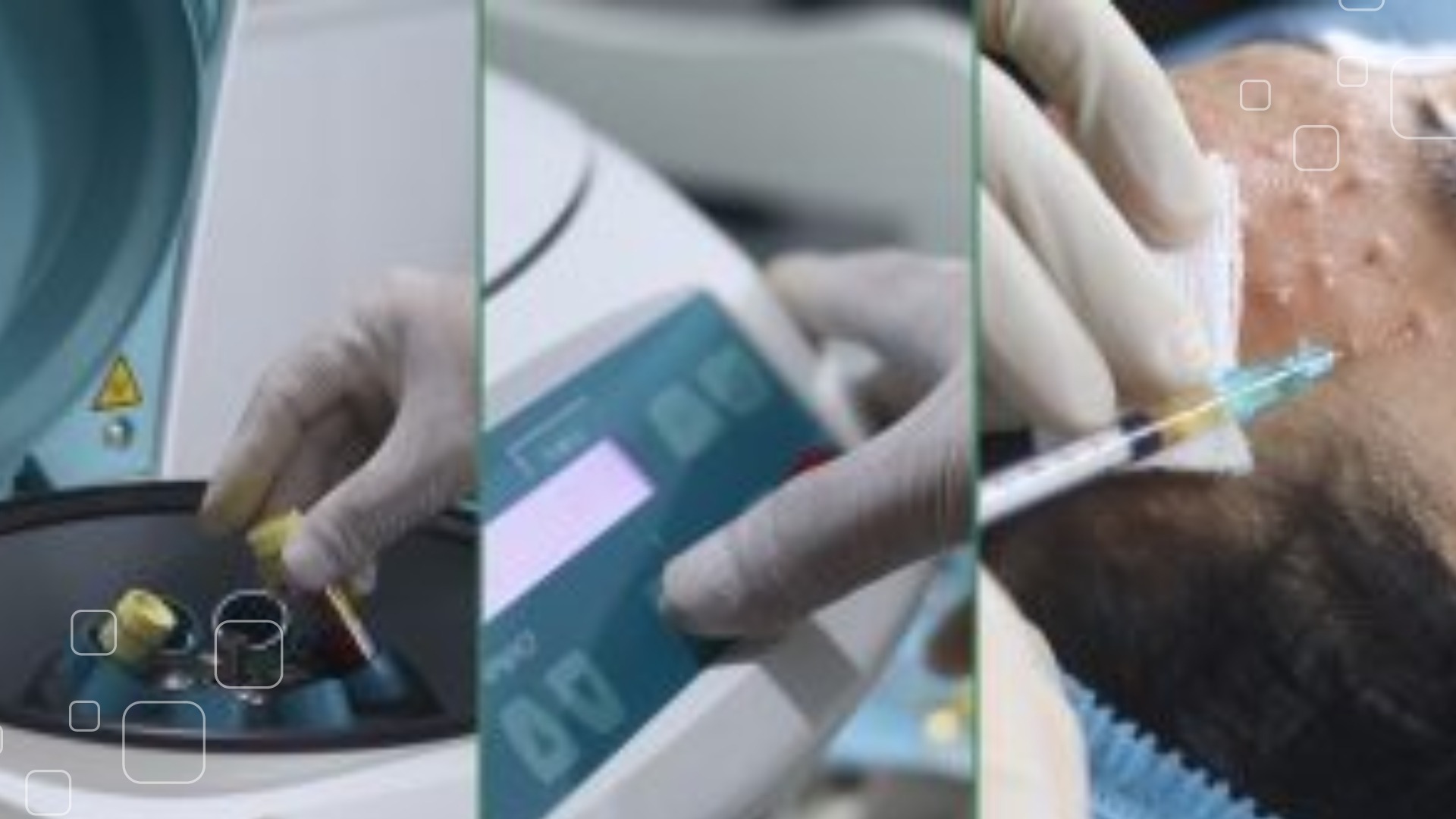 Quy trình trị sẹo lõm bằng công nghệ Bio Scar chuẩn khoa học