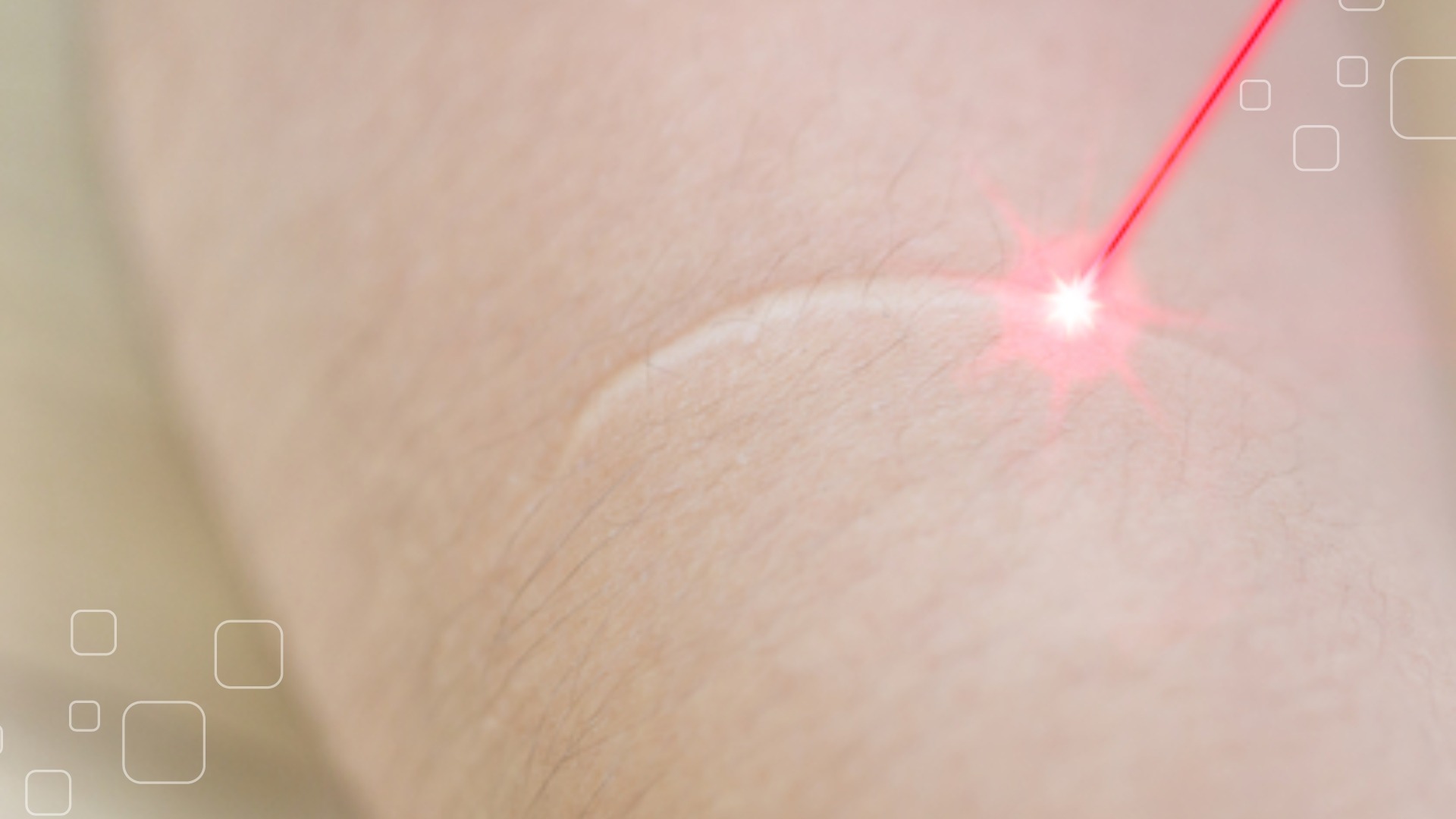 Trị sẹo lồi bằng laser có an toàn và hiệu quả không?