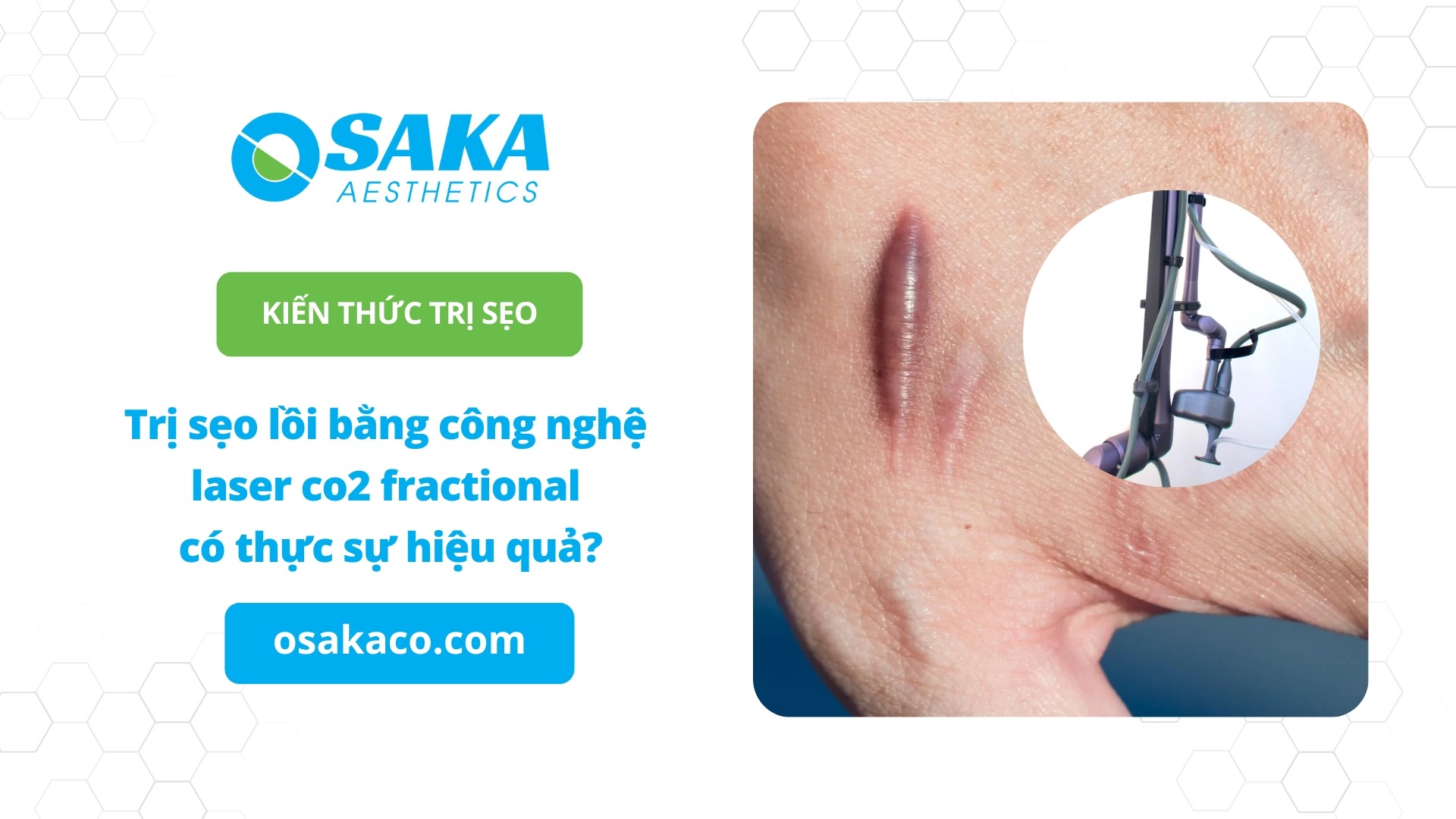 trị sẹo lồi bằng laser co2 fractional
