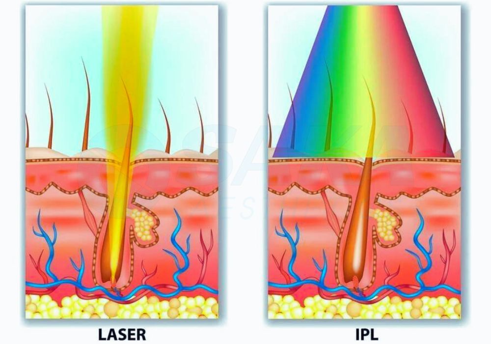 So sánh công nghệ triệt lông DIode Laser và IPL