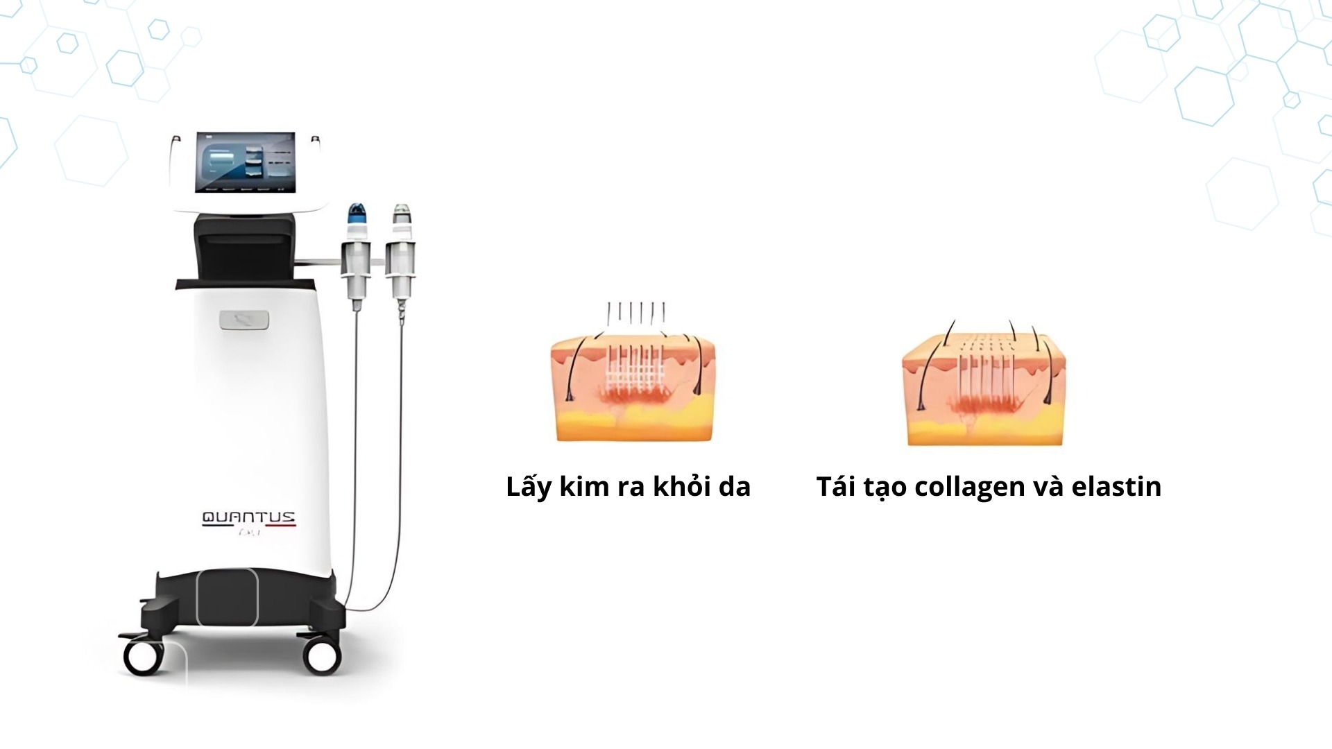 Giới thiệu về máy nâng cơ RF Needles