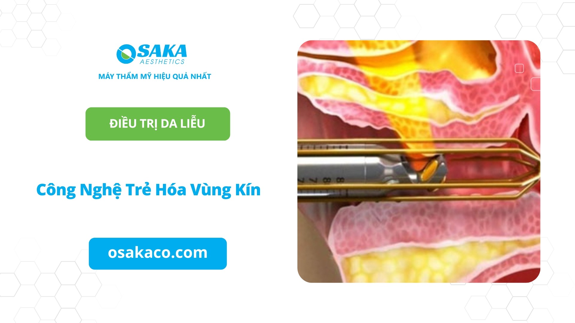 Công nghệ trẻ hóa vùng kín