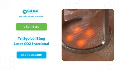 Trị sẹo lồi bằng Laser CO2 Fractional
