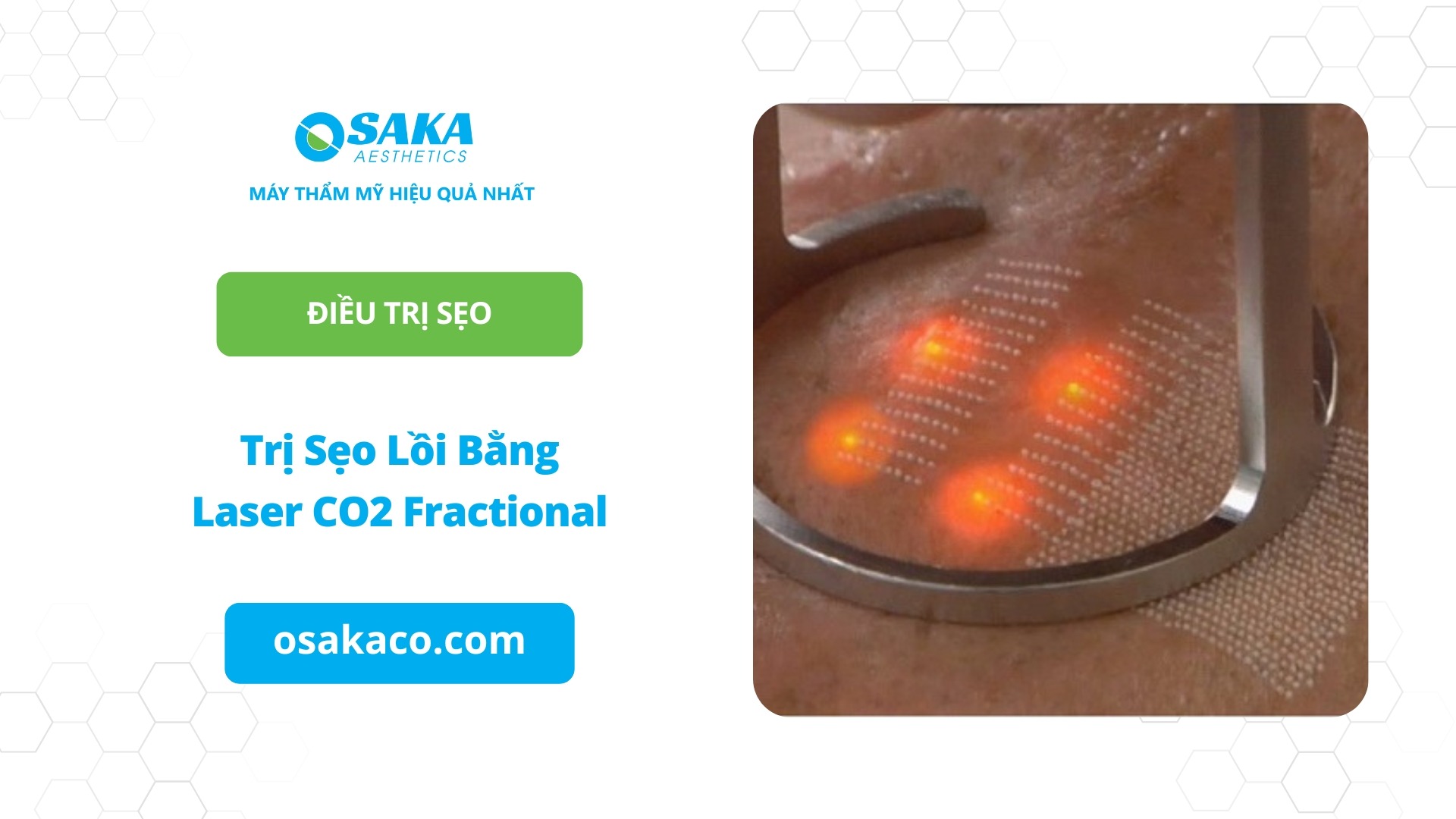 Trị sẹo lồi bằng Laser CO2 Fractional