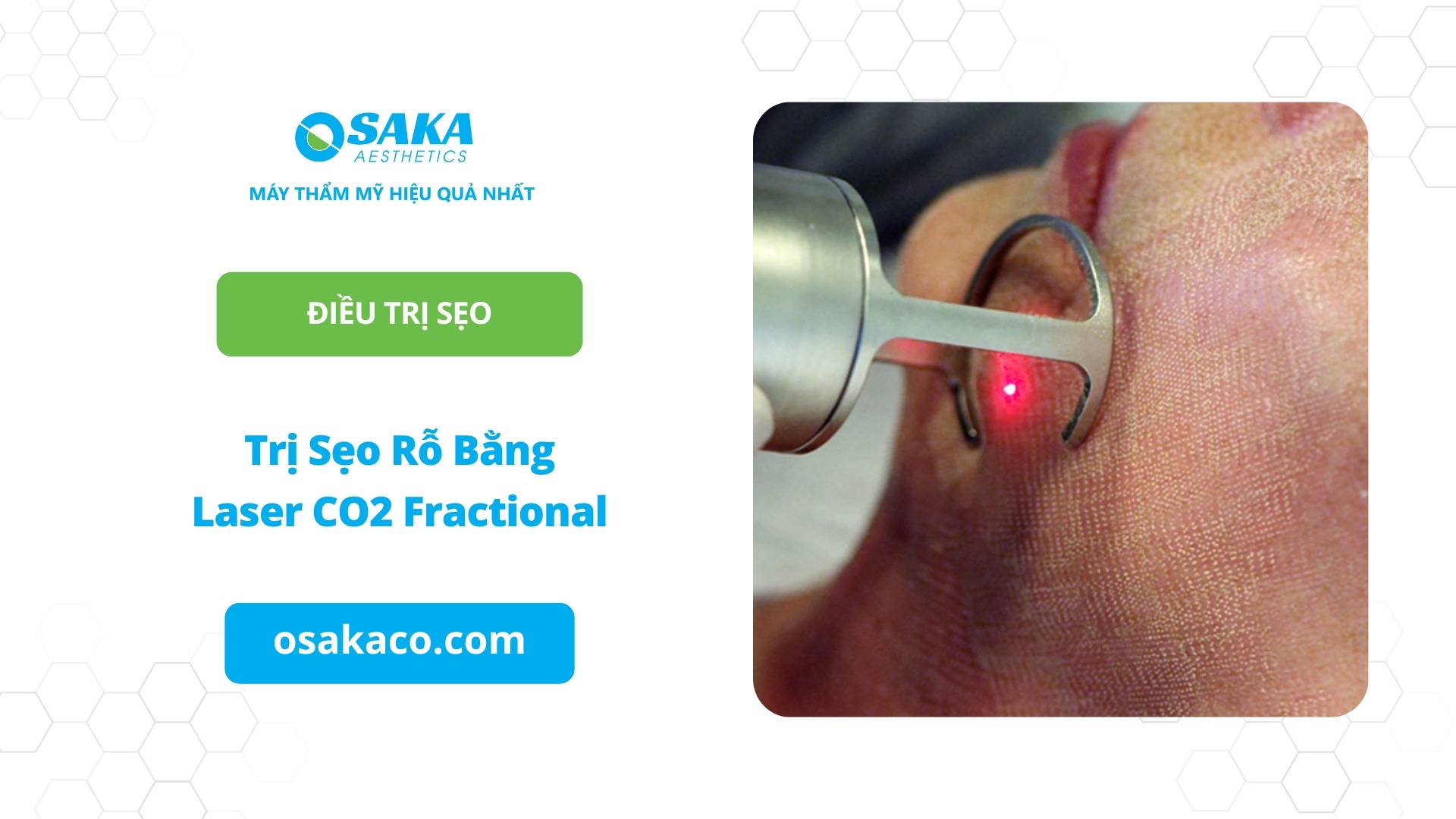 Trị sẹo rỗ bằng Laser CO2 Fractional