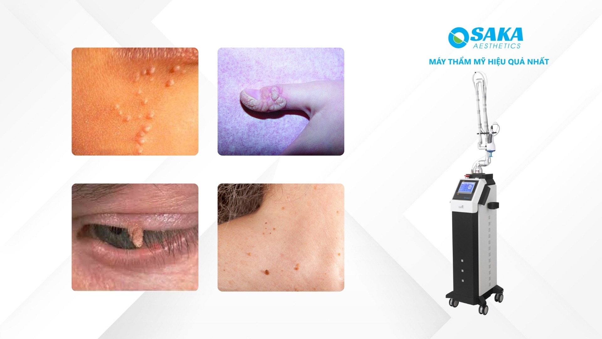 Tính năng nổi bật Laser CO2 Fractional Multixel