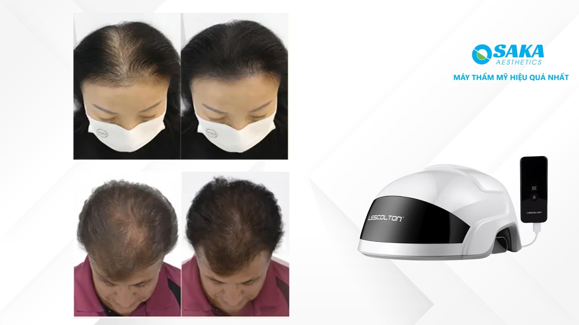 Ứng dụng Nón Laser Mọc Tóc Giảm Dầu Chân Tóc – LESCOLTON LS‑D613