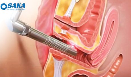 Công nghệ trẻ hóa vùng kín Công nghệ trẻ hóa vùng kín