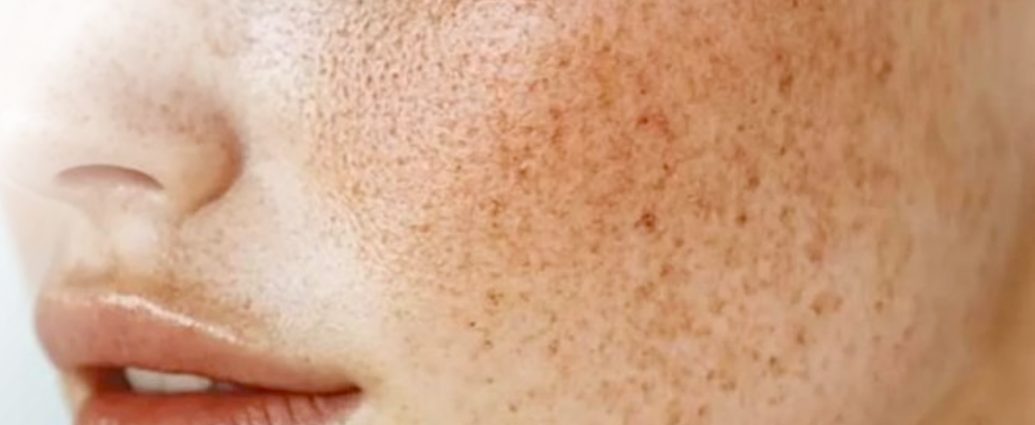 Điều trị nám Hori – Giải pháp điều trị nám hiệu quả