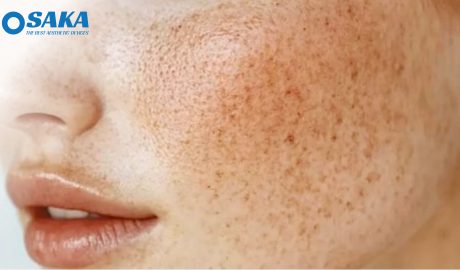 Điều trị nám Hori – Giải pháp điều trị nám hiệu quả Điều trị nám Hori – Giải pháp điều trị nám hiệu quả