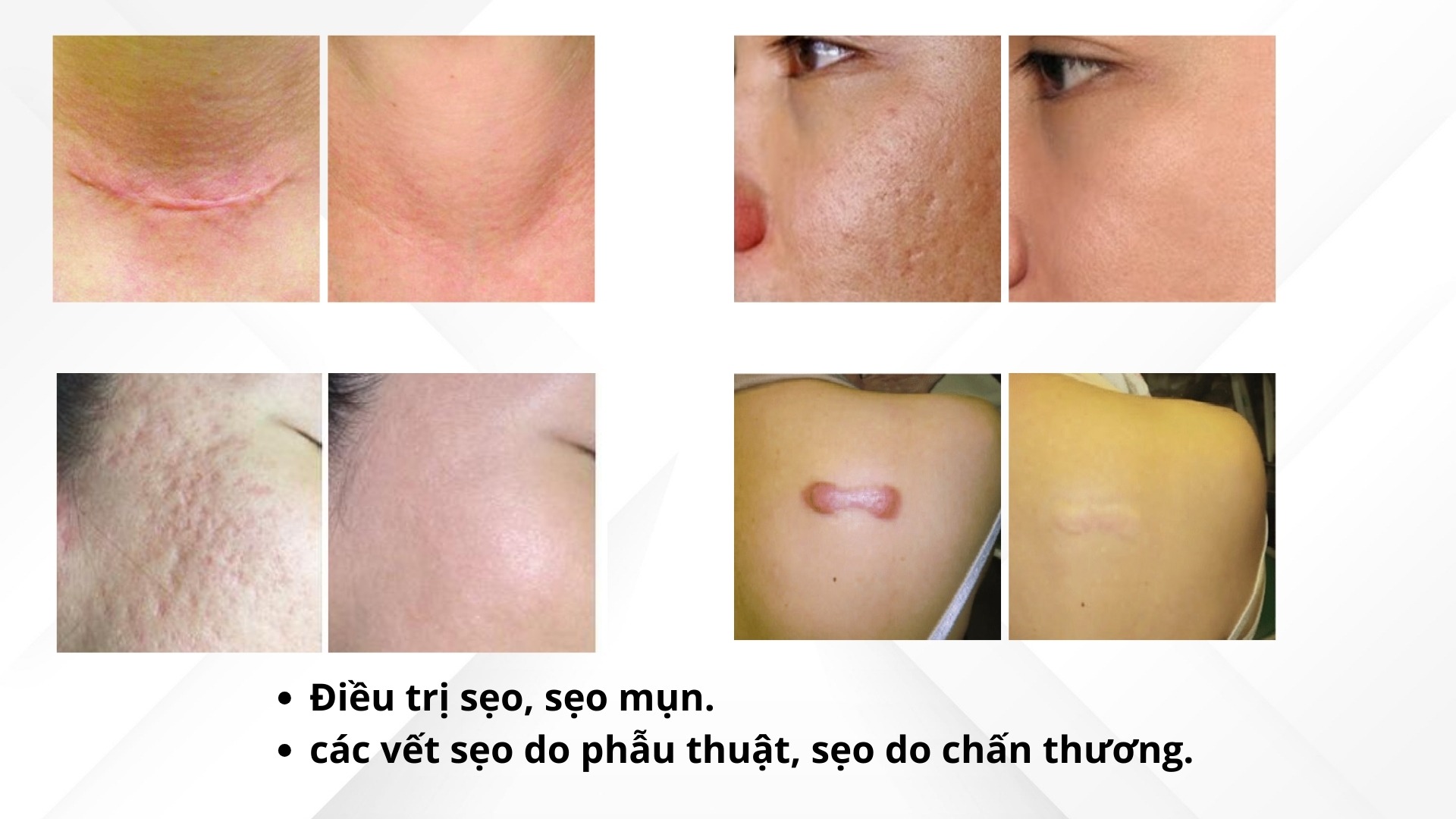 Máy Trị Sẹo, Trẻ Hóa Da Laser CO2 Fractional OSAKA DERMACLEAR Model FG900S Android Điều trị sẹo