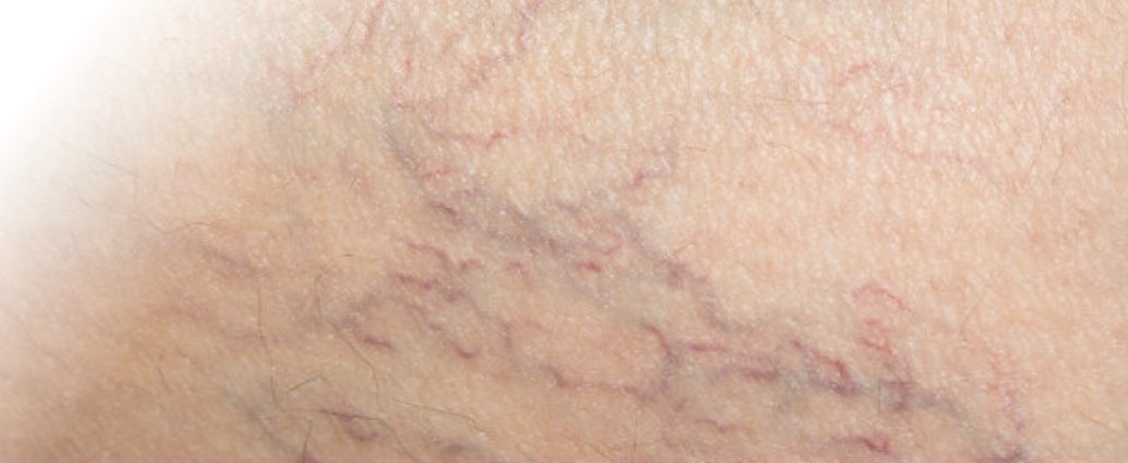 Giãn mao mạch là gì? Nguyên nhân, dấu hiệu và cách điều trị hiệu quả nhất hiện nay Giãn mao mạch là gì? Nguyên nhân, dấu hiệu và cách điều trị hiệu quả nhất hiện nay