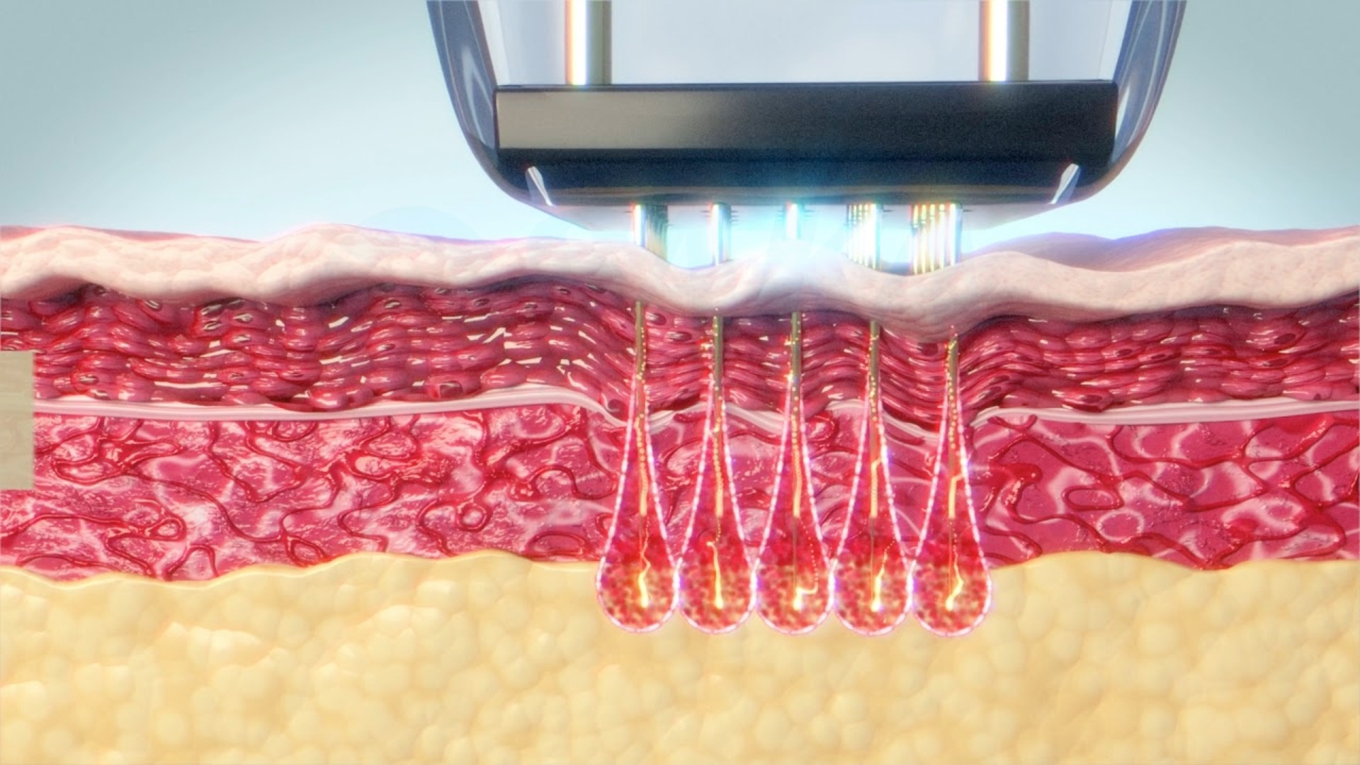 Mô phỏng công nghệ RF Needle