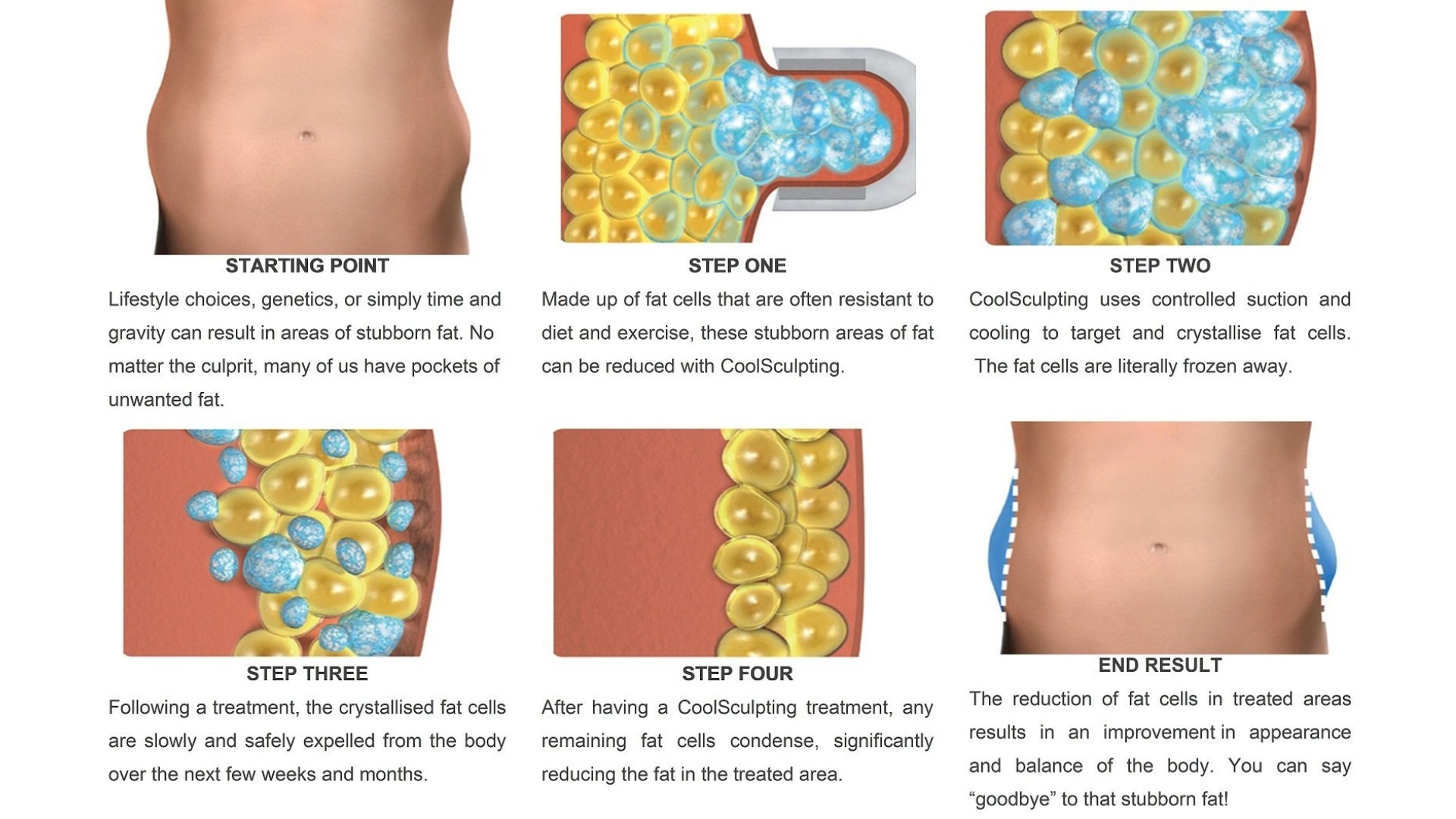 Máy Giảm Béo Quang Đông Apolo Cryoslim Model HS580 Mô phỏng quá trình điều trị