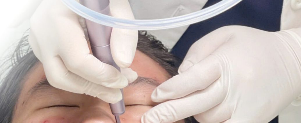 Trị mụn bằng Laser CO2 Fractional – Giải pháp điều trị mụn hiệu quả