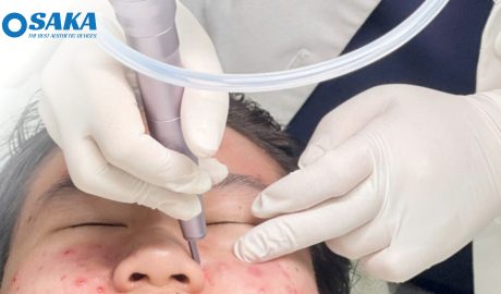 Trị mụn bằng Laser CO2 Fractional – Giải pháp điều trị mụn hiệu quả Trị mụn bằng Laser CO2 Fractional – Giải pháp điều trị mụn hiệu quả