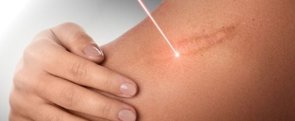 Trị sẹo lồi bằng Laser CO2 Fractional – Giải pháp an toàn và hiệu quả nhất Trị sẹo lồi bằng Laser CO2 Fractional – Giải pháp an toàn và hiệu quả nhất