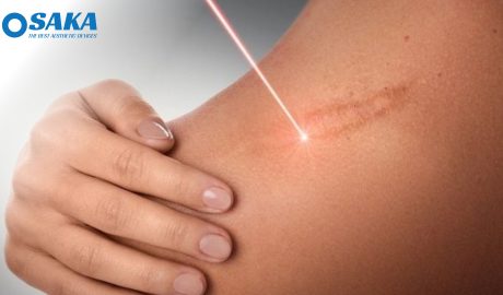 Trị sẹo lồi bằng Laser CO2 Fractional – Giải pháp an toàn và hiệu quả nhất Trị sẹo lồi bằng Laser CO2 Fractional – Giải pháp an toàn và hiệu quả nhất