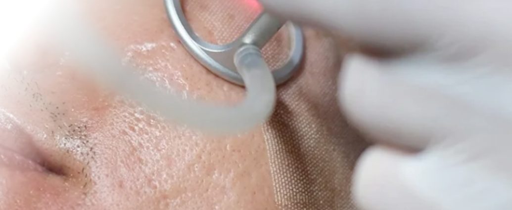Trị sẹo rỗ bằng Laser CO2 Fractional – Giải pháp tái tạo da hiệu quả nhất Trị sẹo rỗ bằng Laser CO2 Fractional – Giải pháp tái tạo da hiệu quả nhất