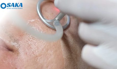 Trị sẹo rỗ bằng Laser CO2 Fractional – Giải pháp tái tạo da hiệu quả nhất Trị sẹo rỗ bằng Laser CO2 Fractional – Giải pháp tái tạo da hiệu quả nhất