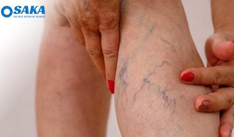 Vỡ mao mạch dưới da là gì? Nguyên nhân, dấu hiệu và cách điều trị hiệu quả Vỡ mao mạch dưới da là gì? Nguyên nhân, dấu hiệu và cách điều trị hiệu quả