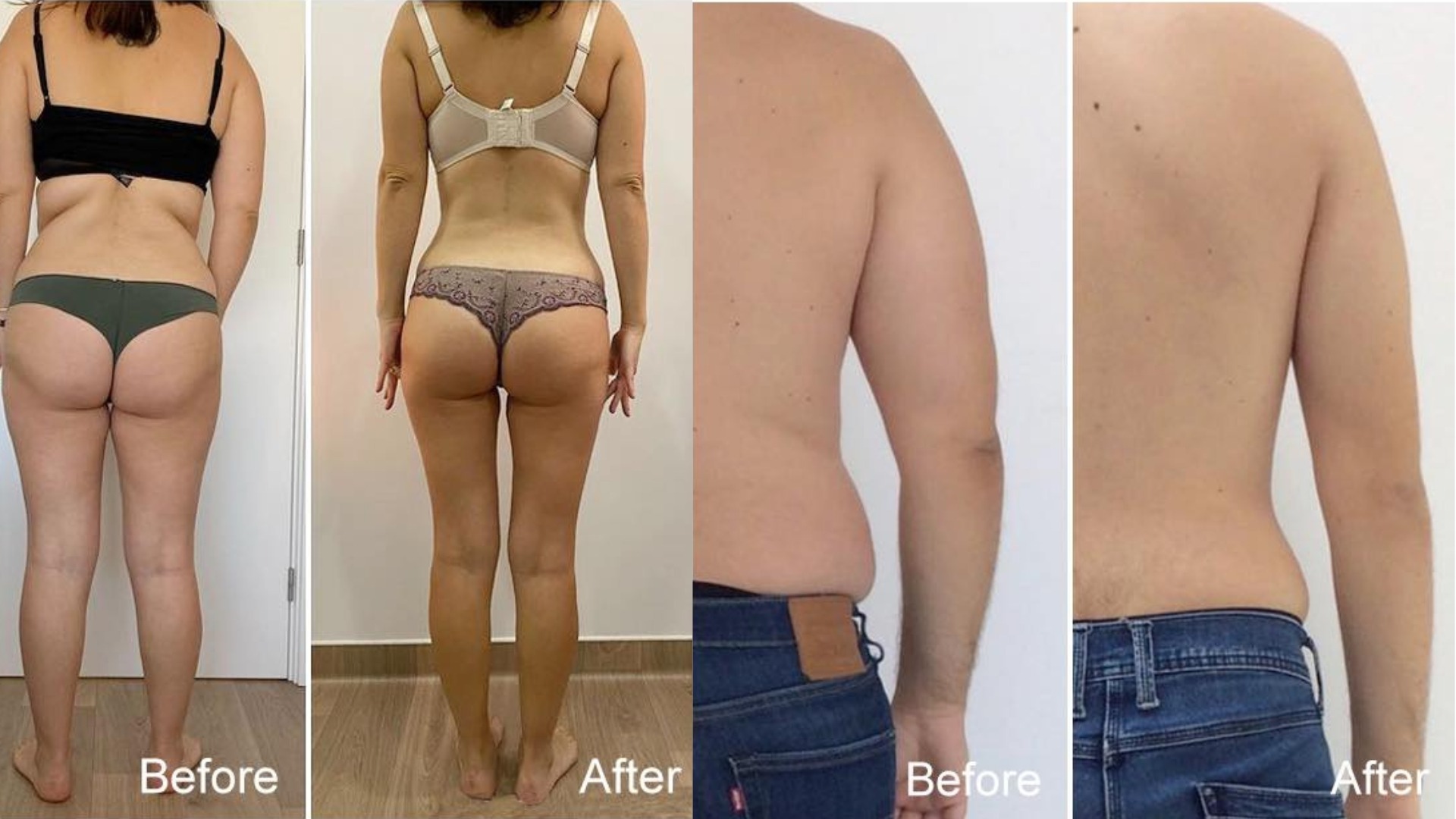 Máy Giảm Béo Quang Đông Apolo Cryoslim Model HS580 Lâm sàng Máy giảm béo quang đông Apolo Cryoslim