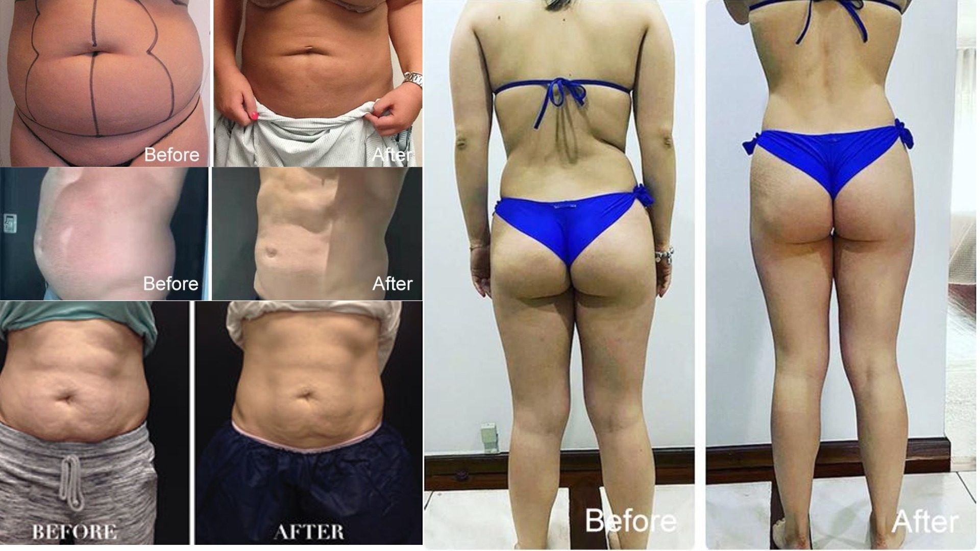 Máy Giảm Béo Quang Đông Apolo Cryoslim Model HS580 Lâm sàng Máy giảm béo quang đông Apolo Cryoslim