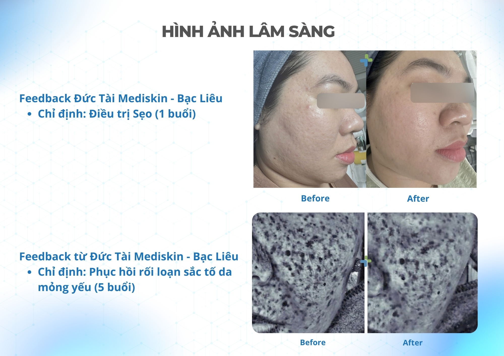 Máy RF Needle Quantus Plus Italy Model H2 Hình ảnh lâm sàng Máy RF Needle Quantus Plus Italy